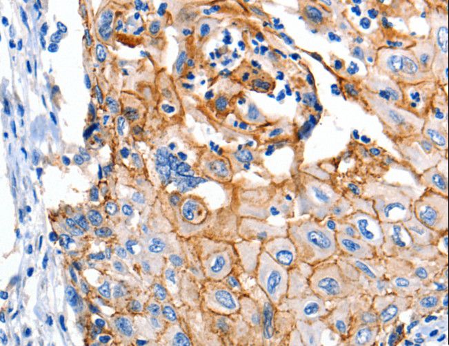 CLDN1 / Claudin 1 Antibody - Immunohistochemistry of paraffin-embedded Human cervical cancer using CLDN1 Polyclonal Antibody at dilution of 1:150.