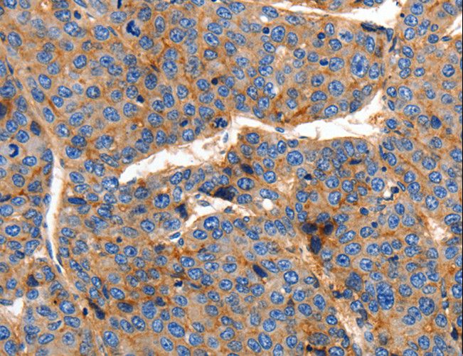 CLDN1 / Claudin 1 Antibody - Immunohistochemistry of paraffin-embedded Human liver cancer using CLDN1 Polyclonal Antibody at dilution of 1:150.