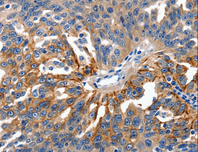 CLDN1 / Claudin 1 Antibody - Immunohistochemistry of paraffin-embedded Human ovarian cancer using CLDN1 Polyclonal Antibody at dilution of 1:150.