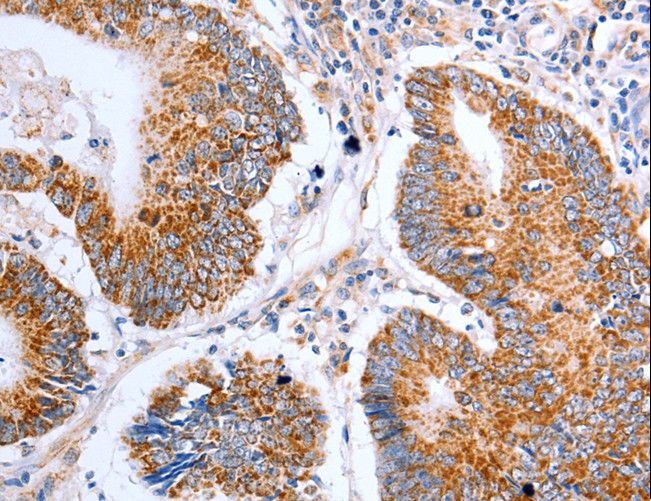CLDN10 / Claudin 10 Antibody - Immunohistochemistry of paraffin-embedded Human liver cancer using CLDN10 Polyclonal Antibody at dilution of 1:50.