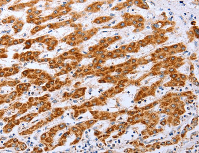 CLDN10 / Claudin 10 Antibody - Immunohistochemistry of paraffin-embedded Human liver cancer using CLDN10 Polyclonal Antibody at dilution of 1:50.