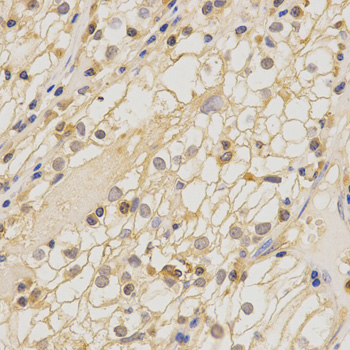 CLDN11 / Claudin 11 Antibody - Immunohistochemistry of paraffin-embedded human kidney cancer using CLDN11 antibody at dilution of 1:200 (x400 lens).