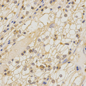 CLDN11 / Claudin 11 Antibody - Immunohistochemistry of paraffin-embedded human kidney cancer using CLDN11 antibody at dilution of 1:200 (x400 lens).