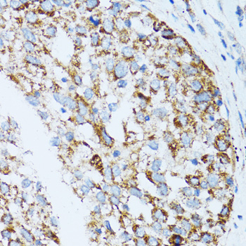CLDN11 / Claudin 11 Antibody - Immunohistochemistry of paraffin-embedded human lung cancer tissue.