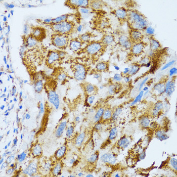 CLDN11 / Claudin 11 Antibody - Immunohistochemistry of paraffin-embedded human breast cancer tissue.