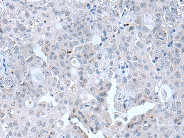 CLDN12 / Claudin 12 Antibody - Immunohistochemistry of paraffin-embedded Human ovarian cancer tissue  using CLDN12 Polyclonal Antibody at dilution of 1:45(×200)