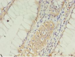 CLDN15 / Claudin 15 Antibody - Immunohistochemistry of paraffin-embedded human colon cancer using antibody at 1:100 dilution.  This image was taken for the unconjugated form of this product. Other forms have not been tested.