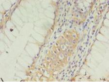 CLDN15 / Claudin 15 Antibody - Immunohistochemistry of paraffin-embedded human colon cancer using antibody at 1:100 dilution.  This image was taken for the unconjugated form of this product. Other forms have not been tested.
