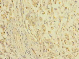 CLDN18 / Claudin 18 Antibody - Immunohistochemistry of paraffin-embedded human gastric cancer at dilution 1:100