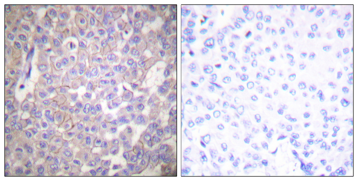 CLDN2 / Claudin 2 Antibody - Immunohistochemistry analysis of paraffin-embedded human breast carcinoma tissue, using Claudin 2 Antibody. The picture on the right is blocked with the synthesized peptide.