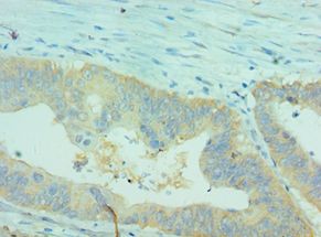 CLDN2 / Claudin 2 Antibody - Immunohistochemistry of paraffin-embedded human colon cancer using antibody 1:100 dilution.