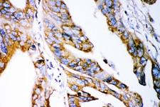 CLDN2 / Claudin 2 Antibody - Claudin 2 antibody IHC-paraffin: Human Intestinal Cancer Tissue.