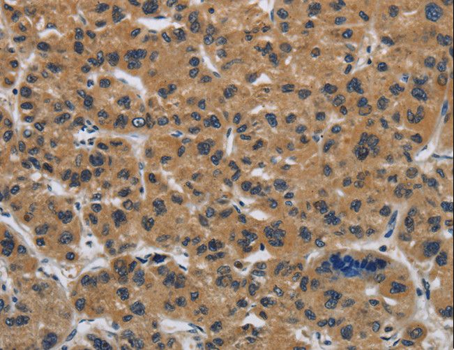 CLDN2 / Claudin 2 Antibody - Immunohistochemistry of paraffin-embedded Human gastric cancer using CLDN2 Polyclonal Antibody at dilution of 1:50.