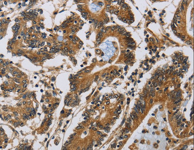 CLDN2 / Claudin 2 Antibody - Immunohistochemistry of paraffin-embedded Human colon cancer using CLDN2 Polyclonal Antibody at dilution of 1:30.