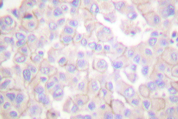 CLDN2 / Claudin 2 Antibody - IHC of Claudin 2 (S219) pAb in paraffin-embedded human breast carcinoma tissue.