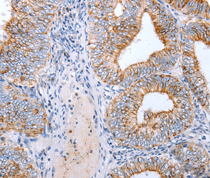CLDN3 / Claudin 3 Antibody - Immunohistochemistry of paraffin-embedded human cervical cancer tissue using CLDN3 antibody.