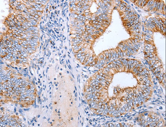 CLDN3 / Claudin 3 Antibody - Immunohistochemistry of paraffin-embedded Human cervical cancer using CLDN3 Polyclonal Antibody at dilution of 1:25.
