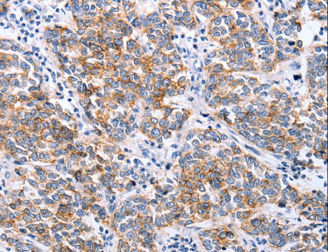 CLDN3 / Claudin 3 Antibody - Immunohistochemistry of paraffin-embedded Human breast cancer using CLDN3 Polyclonal Antibody at dilution of 1:25.