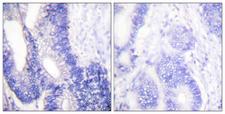 CLDN3 / Claudin 3 Antibody - Peptide - + Immunohistochemical analysis of paraffin-embedded human colon carcinoma tissue using Claudin 3 antibody.