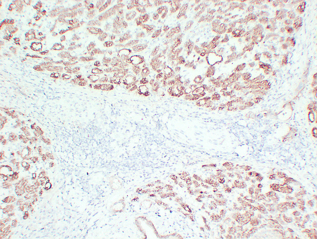 CLDN4 / Claudin 4 Antibody - Pancreatic Carcinoma