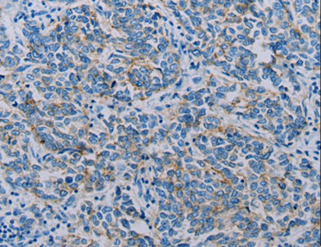 CLDN4 / Claudin 4 Antibody - Immunohistochemistry of paraffin-embedded Human breast cancer using CLDN4 Polyclonal Antibody at dilution of 1:35.