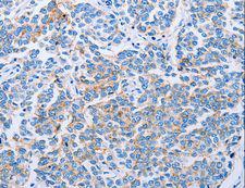 CLDN4 / Claudin 4 Antibody - Immunohistochemistry of paraffin-embedded Human breast cancer using CLDN4 Polyclonal Antibody at dilution of 1:50.