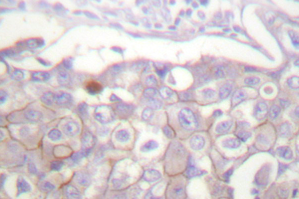 CLDN4 / Claudin 4 Antibody - IHC of Claudin 4 (P192) pAb in paraffin-embedded human breast carcinoma tissue.