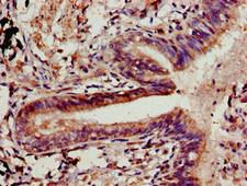 CLDN5 / Claudin 5 Antibody - Immunohistochemistry image of paraffin-embedded human lung cancer at a dilution of 1:100