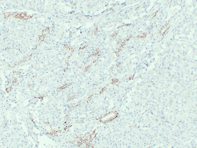 CLDN7 / Claudin 7 Antibody - Chromophobe Cell Renal Carcinoma