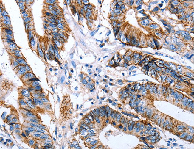 CLDN7 / Claudin 7 Antibody - Immunohistochemistry of paraffin-embedded Human colon cancer using CLDN7 Polyclonal Antibody at dilution of 1:50.