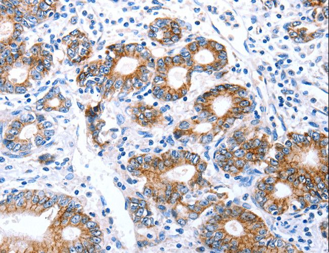 CLDN7 / Claudin 7 Antibody - Immunohistochemistry of paraffin-embedded Human stomach cancer using CLDN7 Polyclonal Antibody at dilution of 1:50.