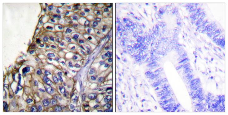 CLDN7 / Claudin 7 Antibody - Peptide - + Immunohistochemical analysis of paraffin-embedded human lung carcinoma tissue using Claudin 7 antibody.