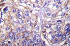 CLDN7 / Claudin 7 Antibody - IHC of Claudin7 (P202) pAb in paraffin-embedded human lung carcinoma tissue.