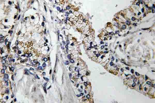 CLDN7 / Claudin 7 Antibody - IHC of VDR (K45) pAb in paraffin-embedded human prostate carcinoma tissue.