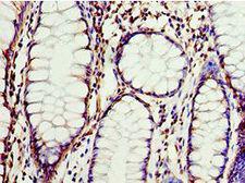 CLDN8 / Claudin 8 Antibody - Immunohistochemistry of paraffin-embedded human colon cancer using antibody at 1:100 dilution.