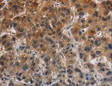 CLDN8 / Claudin 8 Antibody - Immunohistochemistry of paraffin-embedded Human gastric cancer using CLDN8 Polyclonal Antibody at dilution of 1:50.