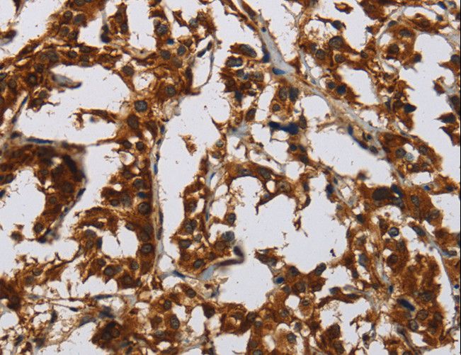 CLDN8 / Claudin 8 Antibody - Immunohistochemistry of paraffin-embedded Human thyroid cancer using CLDN8 Polyclonal Antibody at dilution of 1:50.