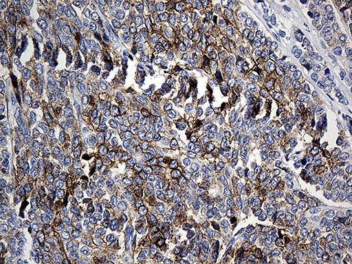 CLEC10A / CD301 Antibody - Immunohistochemical staining of paraffin-embedded Adenocarcinoma of Human breast tissue tissue using anti-CLEC10A mouse monoclonal antibody. (Heat-induced epitope retrieval by 1mM EDTA in 10mM Tris buffer. (pH8.5) at 120°C for 3 min. (1:500)