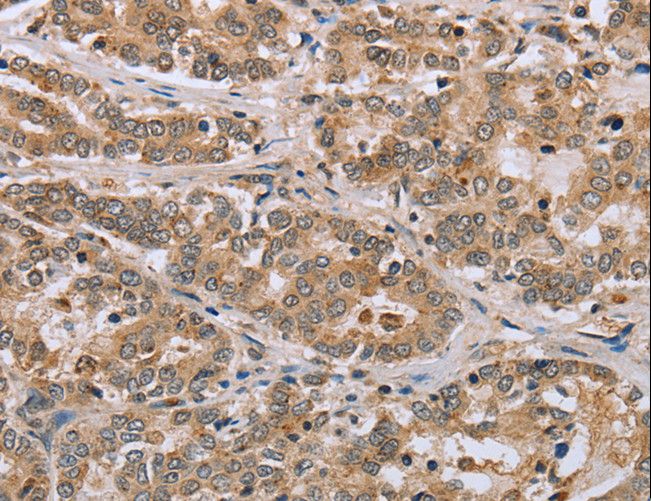 CLEC16A / KIAA0350 Antibody - Immunohistochemistry of paraffin-embedded Human liver cancer using CLEC16A Polyclonal Antibody at dilution of 1:45.