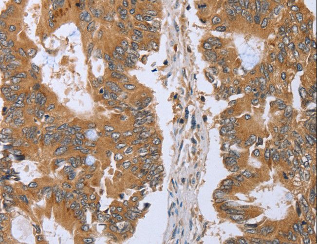 CLEC16A / KIAA0350 Antibody - Immunohistochemistry of paraffin-embedded Human colon cancer using CLEC16A Polyclonal Antibody at dilution of 1:45.