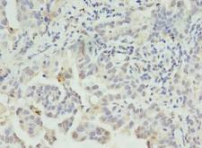 CLEC1A / CLEC-1 Antibody - Immunohistochemistry of paraffin-embedded human lung cancer using antibody at dilution of 1:100.