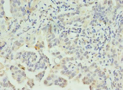 CLEC1A / CLEC-1 Antibody - Immunohistochemistry of paraffin-embedded human lung cancer using CLEC1A Antibody at dilution of 1:100
