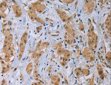 CLEC1A / CLEC-1 Antibody - Immunohistochemistry of paraffin-embedded Human thyroid cancer using CLEC1A Polyclonal Antibody at dilution of 1:40.