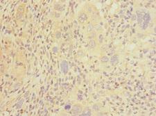 CLEC1B / CLEC-2 Antibody - Immunohistochemistry of paraffin-embedded human liver cancer at dilution 1:100