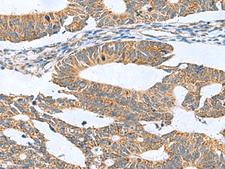 CLEC1B / CLEC-2 Antibody - Immunohistochemistry of paraffin-embedded Human colorectal cancer tissue  using CLEC1B Polyclonal Antibody at dilution of 1:60(×200)