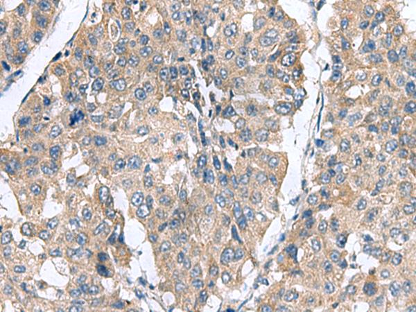 CLEC1B / CLEC-2 Antibody - Immunohistochemistry of paraffin-embedded Human liver cancer tissue  using CLEC1B Polyclonal Antibody at dilution of 1:60(×200)