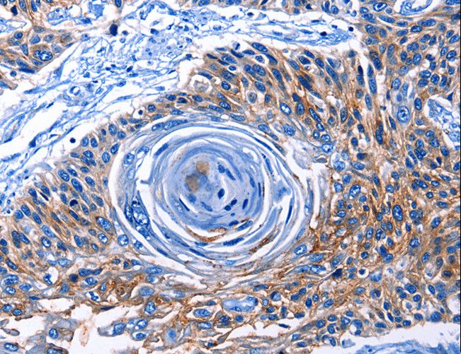 CLEC2B / AICL Antibody - Immunohistochemistry of paraffin-embedded Human esophagus cancer using CLEC2B Polyclonal Antibody at dilution of 1:50.