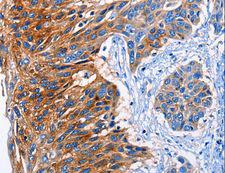 CLEC2B / AICL Antibody - Immunohistochemistry of paraffin-embedded Human esophagus cancer using CLEC2B Polyclonal Antibody at dilution of 1:50.