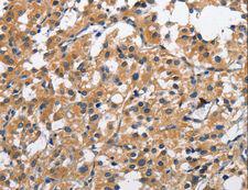 CLEC2D / OCIL / LLT1 Antibody - Immunohistochemistry of paraffin-embedded Human liver cancer using CLEC2D Polyclonal Antibody at dilution of 1:70.