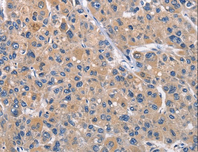 CLEC2D / OCIL / LLT1 Antibody - Immunohistochemistry of paraffin-embedded Human liver cancer using CLEC2D Polyclonal Antibody at dilution of 1:70.